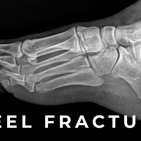 Stress Fracture of the Heel Bone