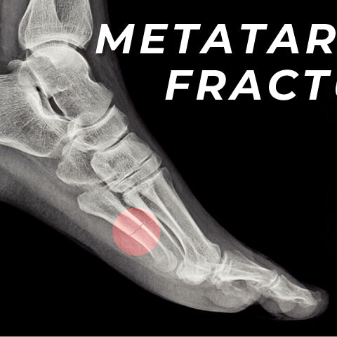 Stress Fracture of the Metatarsal Bones